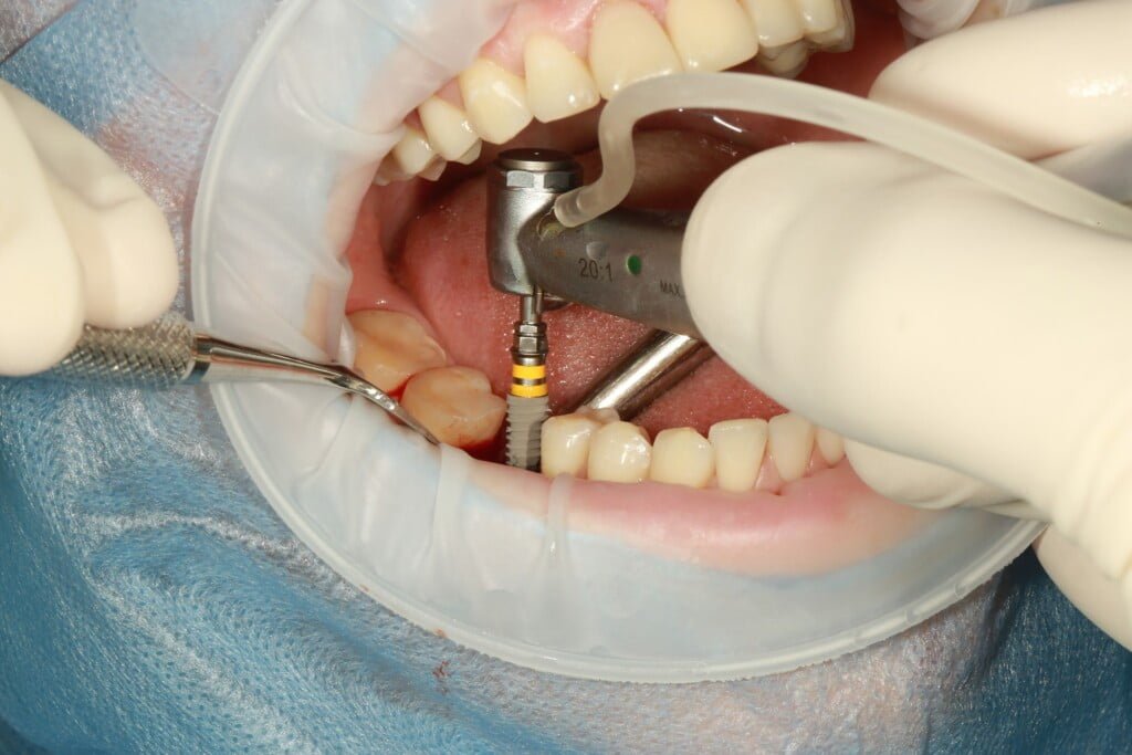 mason-dental-implant-blog