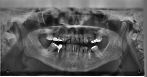 Mason Dentistry - Dental X-Rays