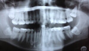 Mason Dentistry Impacted Wisdom Teeth Removal