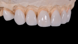 dental, porcelain tooth, wax separated by commas-2036945.jpg